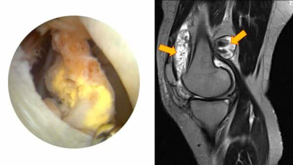 Sinovite Vilonodular Pigmentada No Joelho Cl Nica Do Joelho