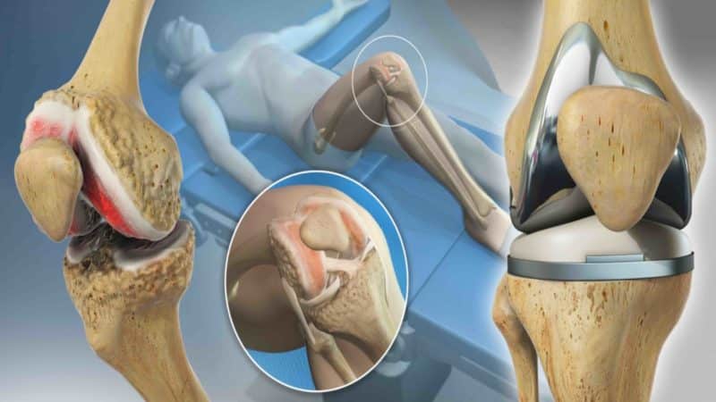 Cirurgia de Prótese de Joelho Clínica do Joelho