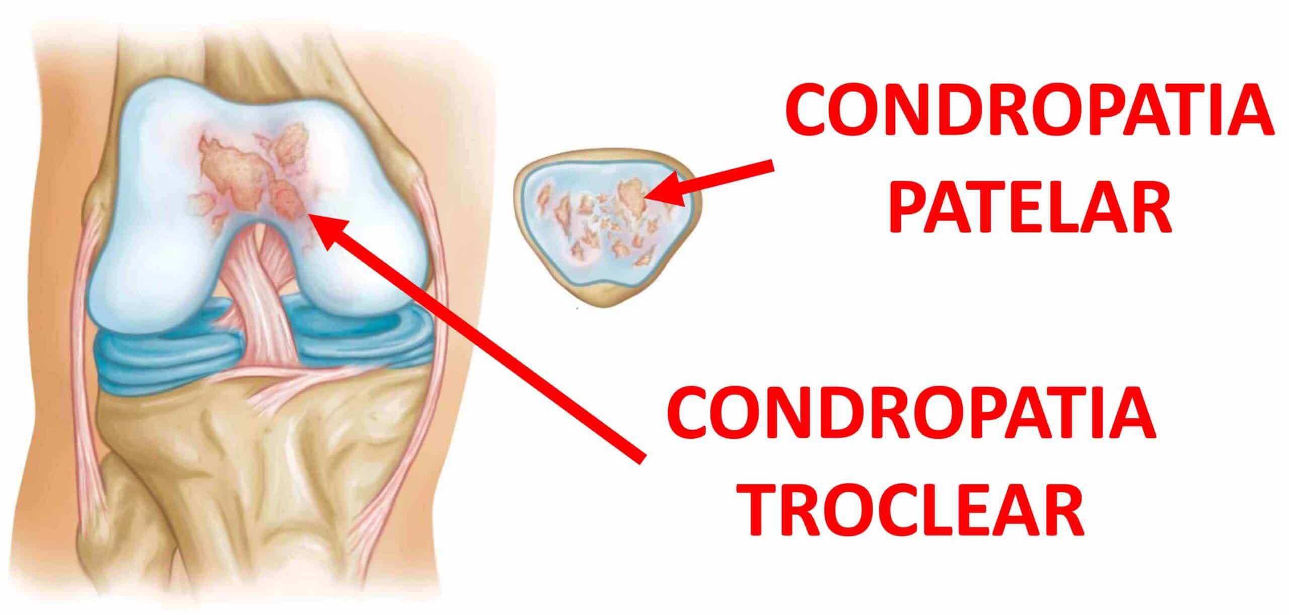 CONDROPATIA PATELOFEMORAL